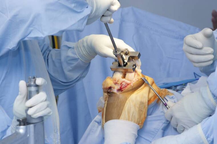 kirurgjia e artrozës së gjurit
