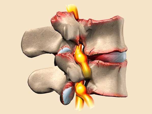 dëmtimi i shtyllës kurrizore në osteokondrozën e kraharorit