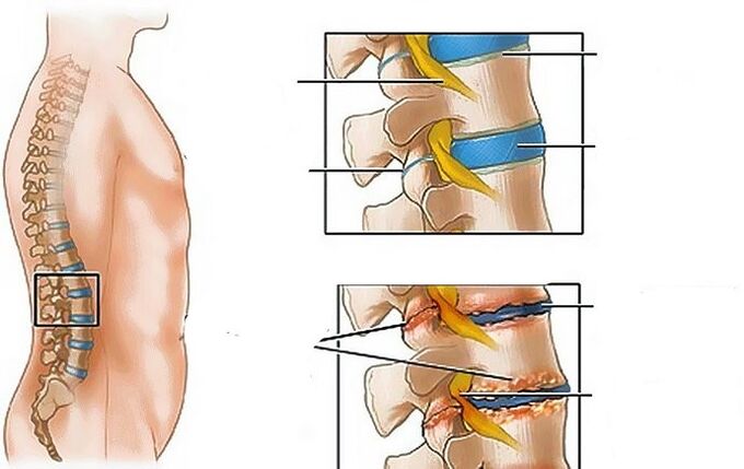 Osteokondroza e rajonit lumbar