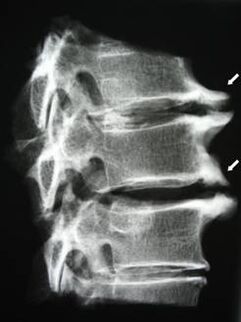Osteofitet e shtyllës së qafës së mitrës shkaktojnë dhimbje në qafë
