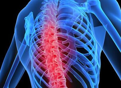 osteokondroza e shtyllës kurrizore torakale