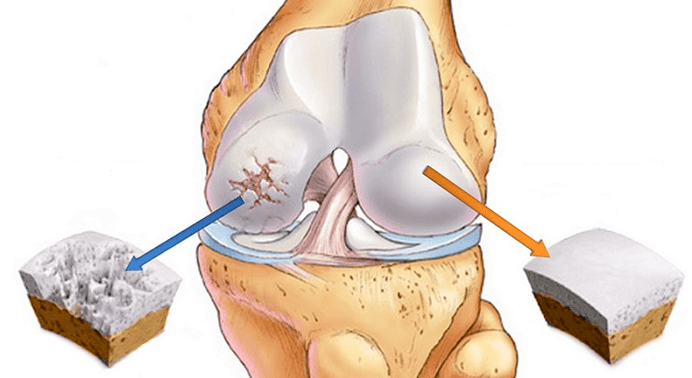 kërc të shëndetshëm dhe kërc të prekur nga artroza
