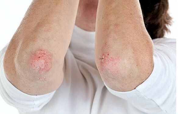 Njerëzit me psoriasis janë të ndjeshëm ndaj artritit psoriatik