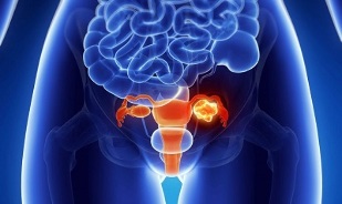 faktorë provokues për zhvillimin e osteokondrozës së shpinës mesit